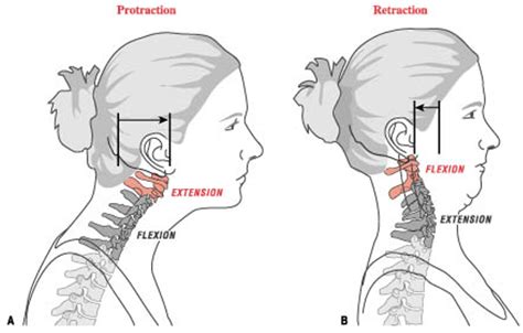 First picture is CAPITAL extension 6x6 #5. (Second picture) is CERVICAL or axial extension ...