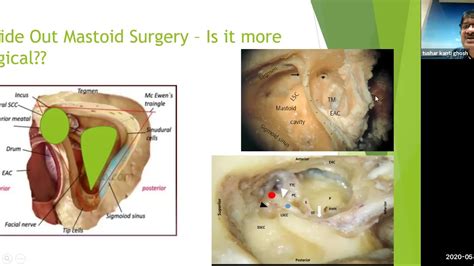 C.S.O.M_SIMPLE WAY MASTOID SURGERY (INSIDE OUT MASTOIDECTOMY WEBINER ...