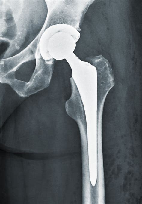 Hip replacement innovations benefit younger patients. — HIMED