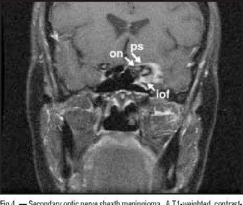 optic nerve sheath meningioma | Semantic Scholar