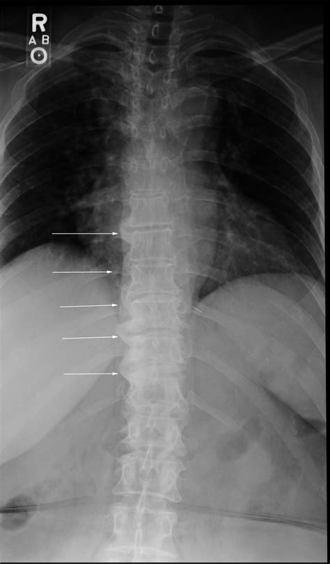 Diffuse Idiopathic Skeletal Hyperostosis (DISH) Quiz