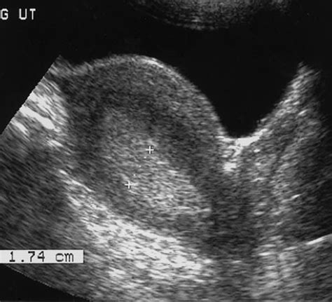 Top 11 Doctor Insights on thickened endometrium ultrasound - HealthTap | Ultrasound, Diagnostic ...