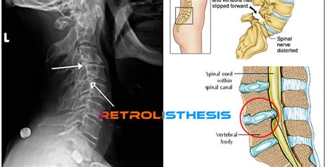 Retrolisthesis - Treatment, Causes, Symptoms, Definition