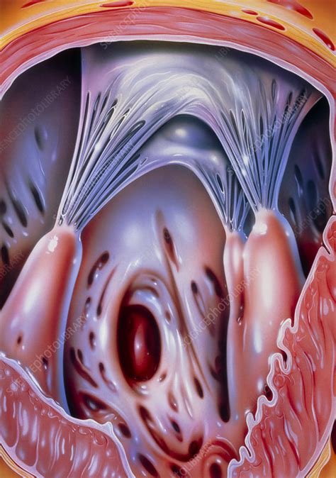 Illustration of a ventricular hole in the heart - Stock Image - M172/0189 - Science Photo Library