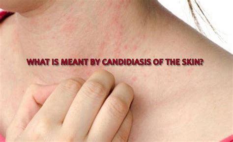 What is meant by candidiasis of the skin? - Yabibo