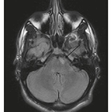 (a) There are few small foci of T2 and FLAIR hyperintensity noted in... | Download Scientific ...