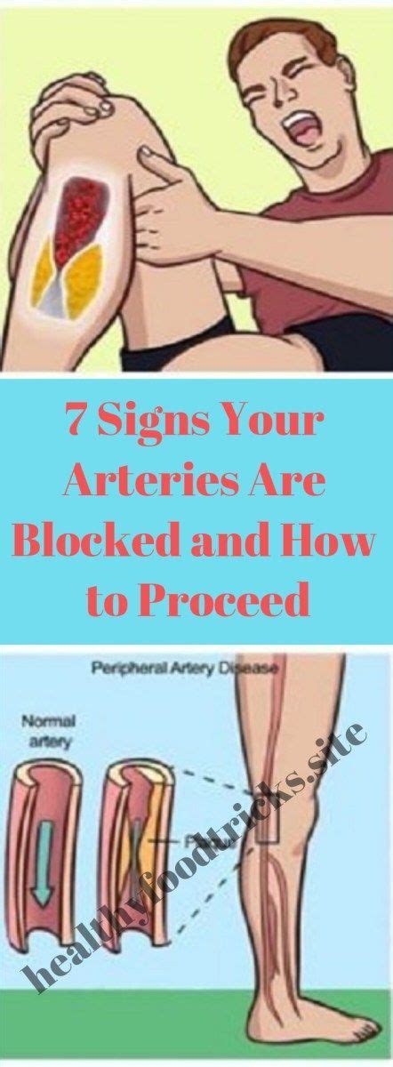 7 Signs Your Arteries Are Blocked and How to Proceed | Arteries ...