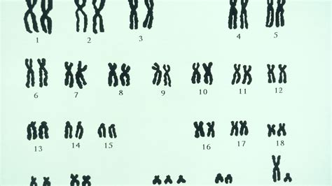 Translocation Down Syndrome Karyotype