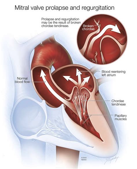 ECHOCARDIOGRAM / mitral valve prolapse