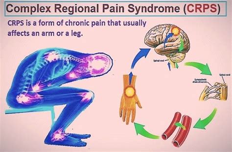 Complex regional pain syndrome crps symptoms causes and treatment – Artofit