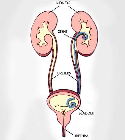 What To Expect After Ureteral Stent Removal - Lamb Difeent