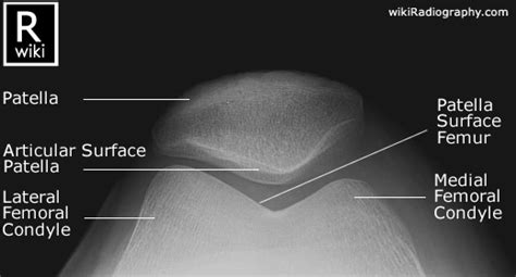 Normal Knee X-rays | Bone and Spine