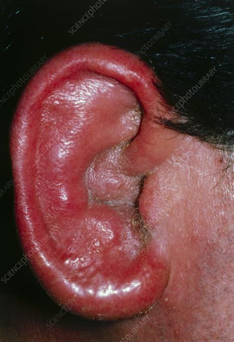 Otitis externa, inflammation of the outer ear - Stock Image M157/0023 ...