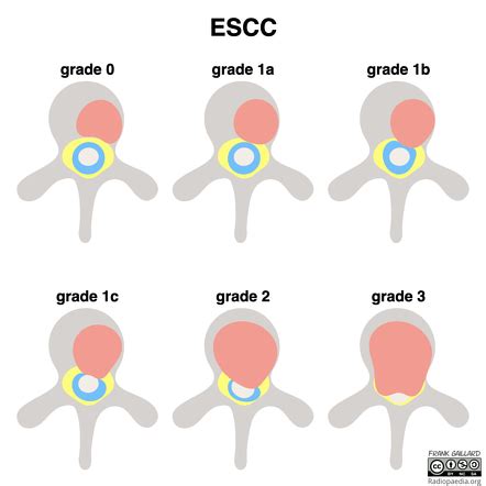 Epidural spinal cord compression (ESCC) scale | Radiology Reference ...