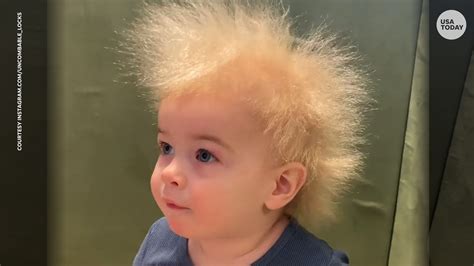 After baby goes viral, expert explains uncombable hair syndrome