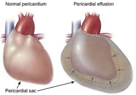 Cardiac tamponade ,Signs and Symptoms, causes ,Pathology, diagnosis and treatment