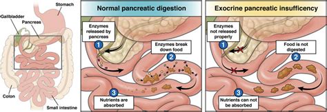 Exocrine pancreatic insufficiency (EPI) - AGA GI Patient Center