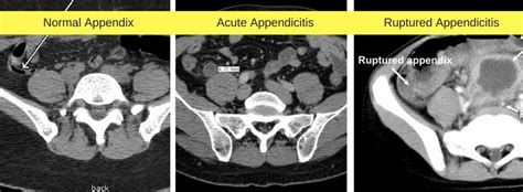 Appendix Removal Surgery in Chennai | Dr. Maran | Gastro Surgeon