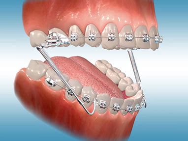 Orthodontic Appliances « The Tooth Mover