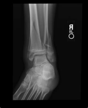 When A Juvenile Patient Presents With A Pilon Fracture