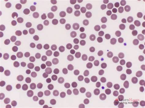 Spherocytes - LearnHaem | Haematology Made Simple