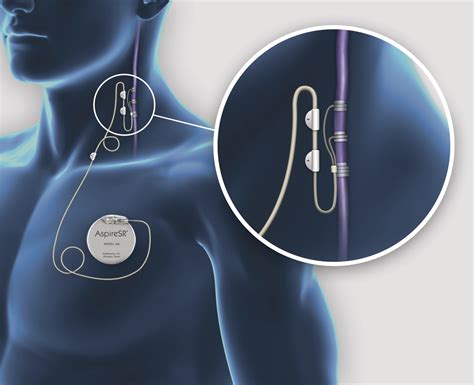 Vagal Nerve Stimulation (VNS) - Pacific Brain Health