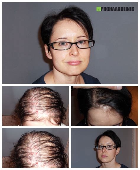 Haartransplantation Kosten | FUE3 Haarverpflanzung Preise| Ergebnisse ...