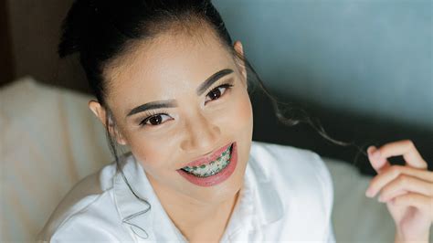 Teeth Whitening After Removing Your Braces? - Glow 2 Go (NYC)