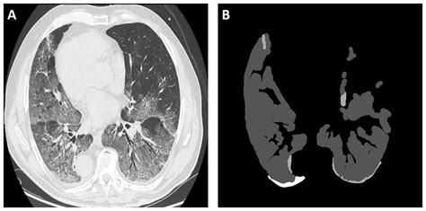 A multi-task pipeline with specialized streams for classification and segmentation of infection ...