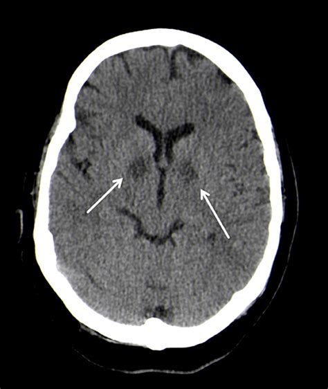 Frontiers | Delayed Post-hypoxic Leukoencephalopathy (DPHL)—An Uncommon Variant of Hypoxic Brain ...