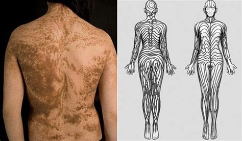 Human skin is actually covered in stripes called Blaschko’s Lines. They ...