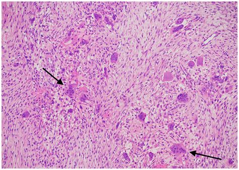 Central Giant Cell Granuloma Histology