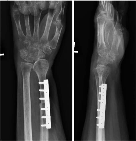 Functional outcome following excision of giant cell tumour of the distal radius and ...