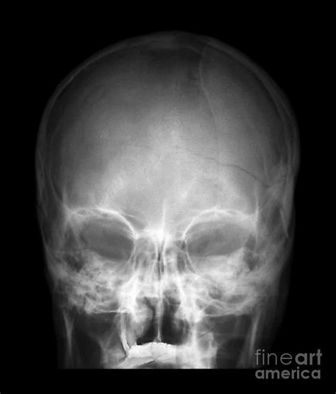 Fractured Skull, X-ray Photograph by Zephyr - Pixels