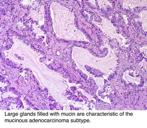 Pathology Outlines - Adenocarcinoma overview