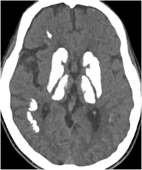 Primary familial brain calcification. A 30-year-old male with primary... | Download Scientific ...