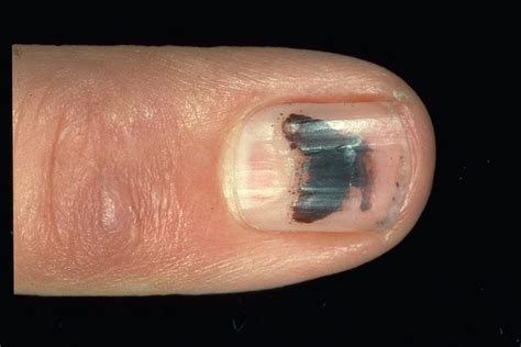 15 Health WARNINGS Your Fingernails May Be Sending