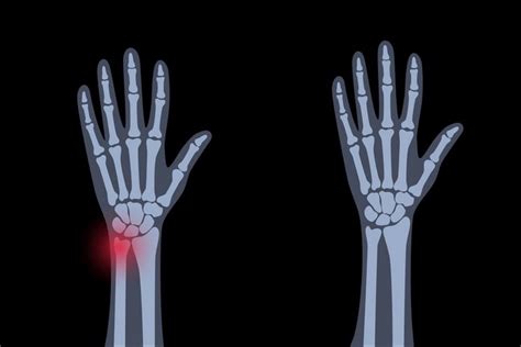 Muscular Dystrophy, Overview, Symptoms, Causes, Types, Treatment, and Management - Page 23 of 36 ...