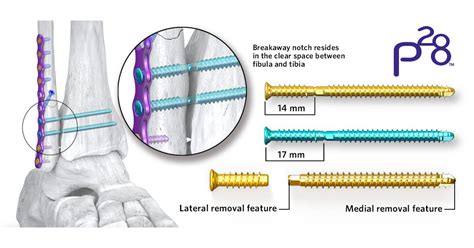 Paragon 28® adds novel syndesmotic repair solution to its robust ankle fracture portfolio ...