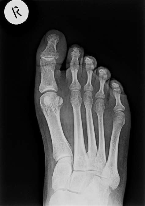 Sesamoid Bone Fracture