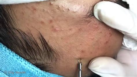 Satisfying Blackhead 2019 - Blackheads Removal - YouTube