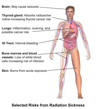 Acute radiation syndrome - Wikipedia