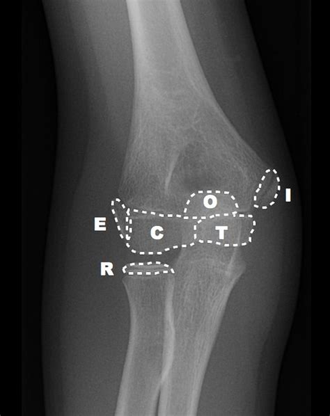 Medial Epicondyle Fracture