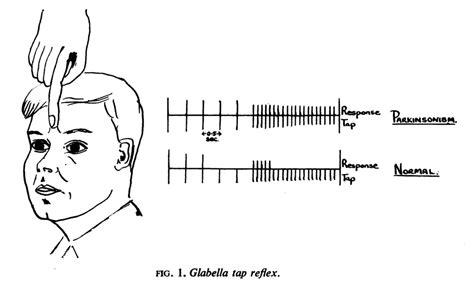 Myerson徴候(Myerson’s sign) / Glabella tap sign/reflex│医學事始 いがくことはじめ