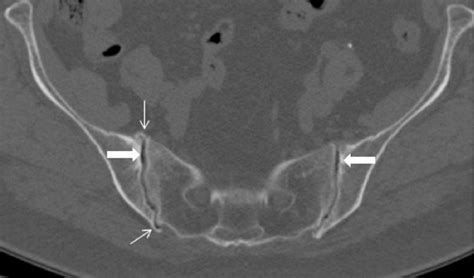 Figure 1 from Sacroiliitis – Findings on Conventional Radiography, CT and MRI studies | Semantic ...