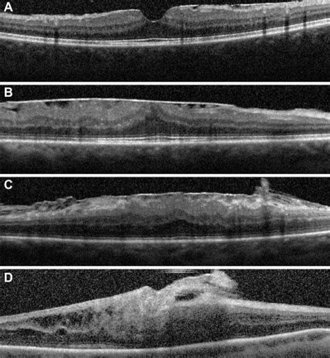 Epiretinal Membrane Surgery after Retinal Detachment Repair: Visual ...