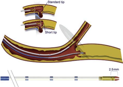 Short-tip IVUS catheter entering side branch to guide CTO crossing ...