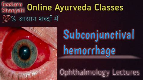 Subconjunctival Hemorrhage अर्जुन - YouTube