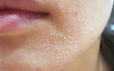 Dry Skin: Causes, Symptoms And Natural Treatment