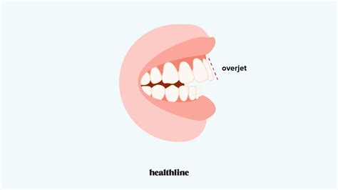 Overjet: Causes, Treatment, vs. Overbite & More